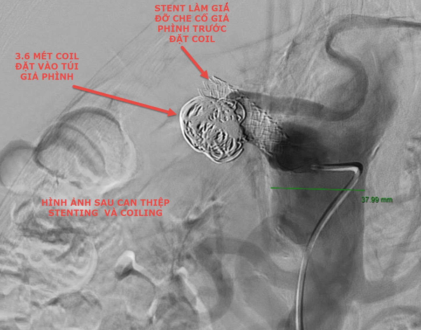 Hình ảnh DSA sau can thiệp mạch tạng cho người bệnh.jpg